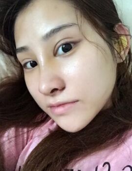 硅胶隆鼻还垫鼻尖了，甘泉涌做的果真的很好哟