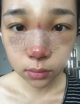 合肥杨鹏隆鼻整形真实案例分享