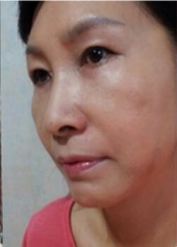 做了电波l皮除皱年轻了十多岁 杭州同欣做的很不错哦