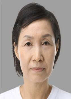 做了电波l皮除皱年轻了十多岁 杭州同欣做的很不错哦