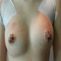 自体脂肪隆胸真的变大胸了 感谢成都天使之翼