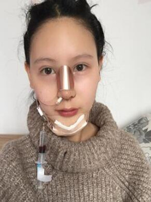 成都天使之翼做隆鼻整形改变了我的塌鼻子 果真的很不错