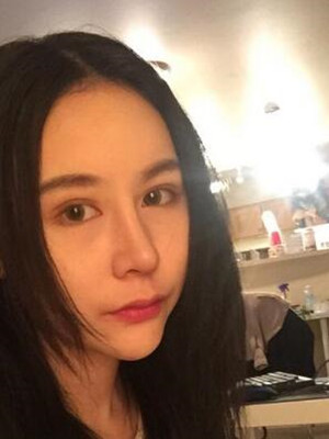 成都天使之翼做隆鼻整形改变了我的塌鼻子 果真的很不错