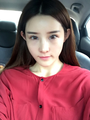 自体脂肪填充全脸后人生像开了挂