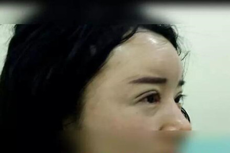 成都天使之翼做的双眼皮修复怎么样 快来围观
