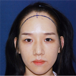 去年在格莱美做了头发种植，看看前后对比和恢复果照片吧~~