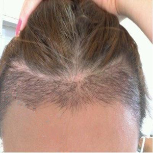 分享我头发种植前后和恢复过程的图片，是格莱美黄兴勇做的哦~~~