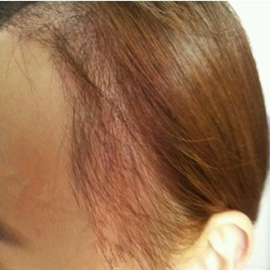 分享我头发种植前后和恢复过程的图片，是格莱美黄兴勇做的哦~~~