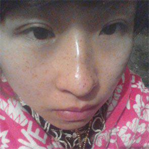 去格莱美做了激光去雀斑，有恢复前后的对比照片哦，还不错~~