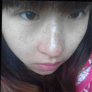 去格莱美做了激光去雀斑，有恢复前后的对比照片哦，还不错~~