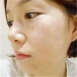 做了激光去雀斑前后对比照片分享，黄俊俊的技术很好哦！