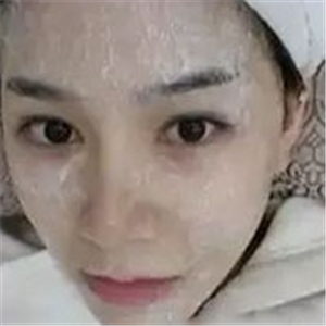 做了激光去雀斑前后对比照片分享，黄俊俊的技术很好哦！