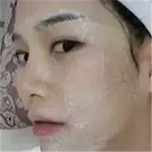 做了激光去雀斑前后对比照片分享，黄俊俊的技术很好哦！