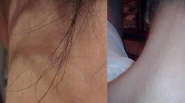 激光脱毛前后对比图，8000元全身激光脱毛