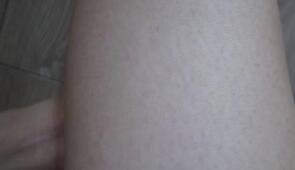 大腿处3次激光脱毛果