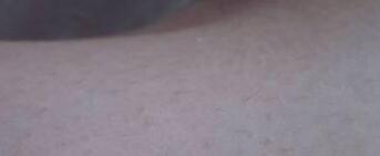 膝盖弯激光脱毛后果图