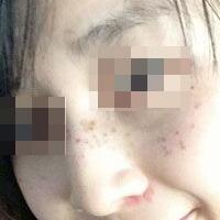 花费4000元做了激光祛斑，终于把雀斑消灭了555555