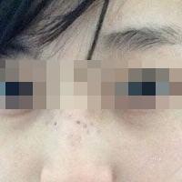 花费4000元做了激光祛斑，终于把雀斑消灭了555555