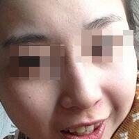 花费4000元做了激光祛斑，终于把雀斑消灭了555555