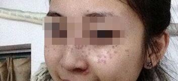 花费4000元做了激光祛斑，终于把雀斑消灭了