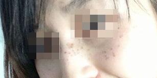 激光祛斑费用4000元