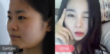 隆鼻前后的对比照片