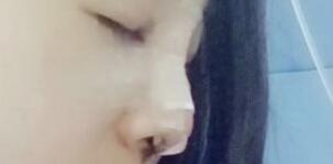 将自己隆鼻恢复过程分享给大家，希望对有需求的MM有帮助