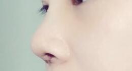 隆鼻术后第6天