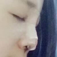 将自己隆鼻恢复过程分享给大家，希望对有需求的MM有帮助