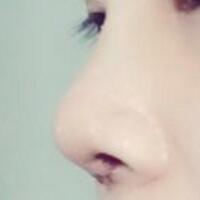 将自己隆鼻恢复过程分享给大家，希望对有需求的MM有帮助