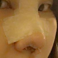 假体隆鼻，耳软骨垫鼻尖，鼻头缩小等隆鼻整形分享