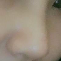 假体隆鼻，耳软骨垫鼻尖，鼻头缩小等隆鼻整形分享