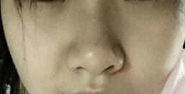 鼻子整形前的图片，隆鼻案例分享