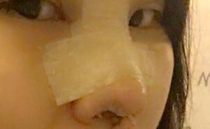 隆鼻整形手术分享