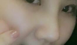 假体隆鼻，耳软骨垫鼻尖，鼻头缩小等隆鼻整形分享