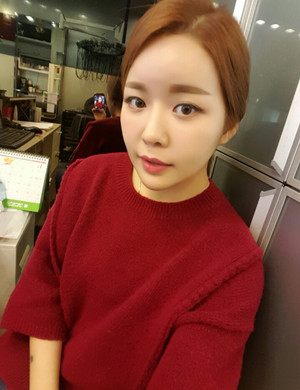 v－line手术后变小脸美眉 伊美尔孙丽君做的