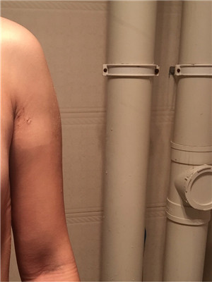 手臂吸脂后变软妹纸 美莱邓正辉做的