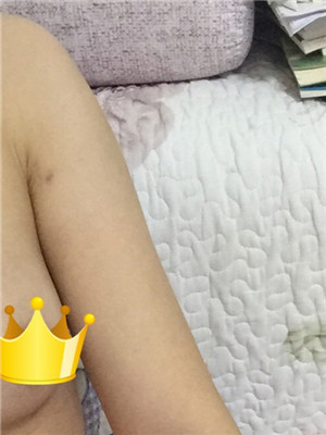 手臂吸脂后变软妹纸 美莱邓正辉做的