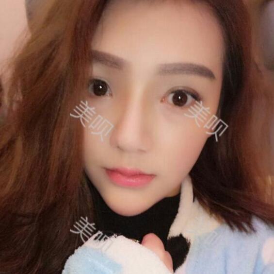 重庆联合丽格做的硅胶假体隆鼻自我感觉很漂亮哦