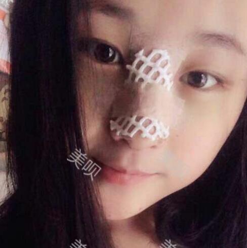 把自己的自体脂肪隆鼻过程分享给大家我是真的变美了