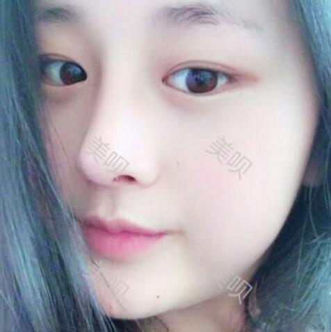 把自己的自体脂肪隆鼻过程分享给大家我是真的变美了