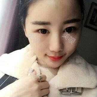 给大家分享下我的自体脂肪面部填充过程希望对大家有帮助