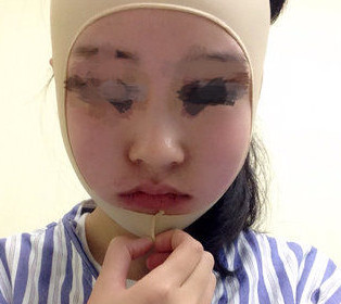 磨骨瘦脸后，终于摆脱大饼脸了！