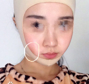 磨骨瘦脸后，终于摆脱大饼脸了！