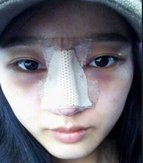 假体隆鼻手术过程前后对比图片