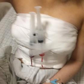 去年10月做的假体隆胸手术，大家来看看怎么样