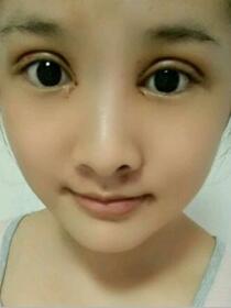 去年12月初在南京韩辰做的双眼皮，大家来看看果怎么样?