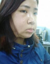 在北京炫美磨了下颌角 恢复纪实分享