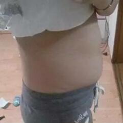 北京炫美腹部吸脂术后 腰腹部吸脂后一周照片