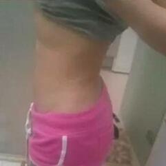 北京炫美腹部吸脂术后 腰腹部吸脂后一周照片